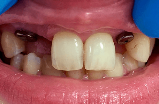 implant-1-min