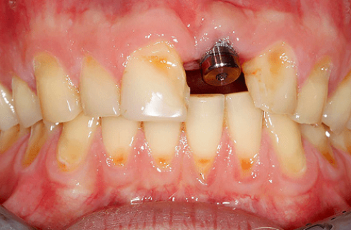implant-3-min